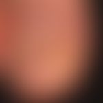 Granuloma pyogenicum (pyogenic granuloma). after manipulation of the onychomycktoically damaged n...