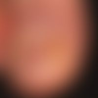 Granuloma pyogenicum (pyogenic granuloma). after manipulation of the onychomycktoically damaged n...
