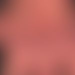 Atrophie&nbsp;der Haut bei Acrodermatitis chronica atrophicans:&nbsp; Deutliche Atrophie der Haut...