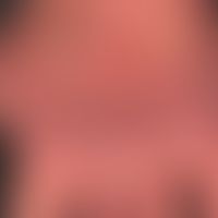 Atrophie&nbsp;der Haut bei Acrodermatitis chronica atrophicans:&nbsp; Deutliche Atrophie der Haut...