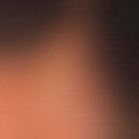 Scleroderma en coup de sabre:hairless, symptom-free, firm, streaky plaque, which has been known f...