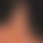 Sclerodermie en coup de sabre (2 Jahre später): weitere Größenzunahme des sklerotischen Areals. &...