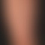Pityriasis lichenoides chronica:&nbsp;20&nbsp;jähriger, ansonsten gesunder&nbsp;Patient, mit dies...