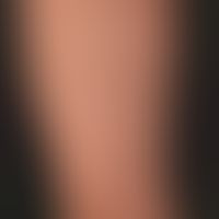 Pityriasis lichenoides chronica:&nbsp;20&nbsp;jähriger, ansonsten gesunder&nbsp;Patient, mit dies...