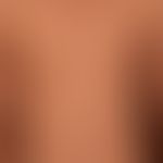 Pityriasis lichenoides chronica:&nbsp;20 jähriger, ansonsten gesunder&nbsp;Patient, mit diesem se...