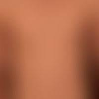 Pityriasis lichenoides chronica:&nbsp;20 jähriger, ansonsten gesunder&nbsp;Patient, mit diesem se...