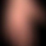 Acute spontaneous urticaria: acutely occurring, itchy exanthema with unpleasantly itchy wheals on...