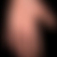 Acute spontaneous urticaria: acutely occurring, itchy exanthema with unpleasantly itchy wheals on...