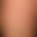 Acute spontaneous urticaria: itchy exanthema of varying size with distinctly jcuking wheals (pers...