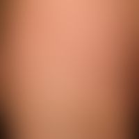 Acute spontaneous urticaria: itchy exanthema of varying size with distinctly jcuking wheals (pers...