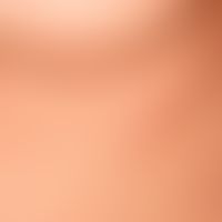 Acute spontaneous urticaria: acutely occurring, itchy exanthema with anular and circine wheals (p...