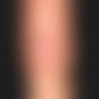 Tinea corporis:a solitary, ring-shaped, sharply defined plaque that has been present for several ...