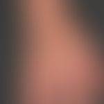 Kumulativ-toxisches Handdermatitis: diffuse, brennende Rötung der Haut bei einer 44 Jahre alten&n...