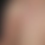 Vaskuläre (kapilläre) Malformation (sog. Naevus flammeus):&nbsp;Kongenitale, generalisierte, unre...