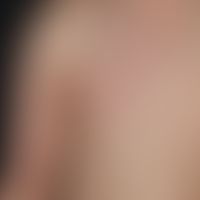 Vaskuläre (kapilläre) Malformation (sog. Naevus flammeus):&nbsp;Kongenitale, generalisierte, unre...