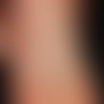 Vaskuläre (kapilläre) Malformation (sog. Naevus flammeus):&nbsp;Kongenitale, generalisierte, unre...