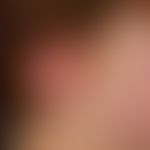 Vaskuläre (kapilläre) Malformation (sog. Naevus flammeus):&nbsp;Kongenitale, generalisierte, flec...