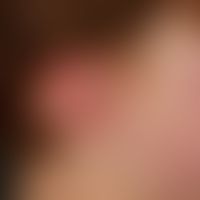 Vaskuläre (kapilläre) Malformation (sog. Naevus flammeus):&nbsp;Kongenitale, generalisierte, flec...
