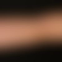 Vaskuläre (kapilläre) Malformation (sog. Naevus flammeus):&nbsp;Kongenitale, generalisierte, unre...