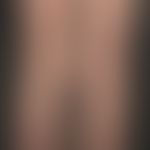 Vaskuläre (kapilläre) Malformation (sog. Naevus flammeus):&nbsp;Kongenitale, generalisierte, unre...