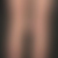 Vaskuläre (kapilläre) Malformation (sog. Naevus flammeus):&nbsp;Kongenitale, generalisierte, unre...