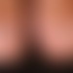 Melanonychia striata: Discreet (harmrous) infestation of the thumbnails on both sides.

