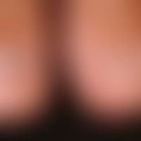 Melanonychia striata: Discreet (harmrous) infestation of the thumbnails on both sides.
