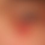 Nodule red: fast growing, firmly elastic, painless nodule with scaly surface. central ulcer forma...