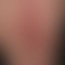 Lichen planus atrophicans. atrophying Lichen planus existing for several years. recurrent, sponta...