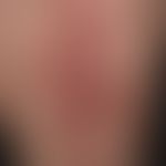 Lichen planus atrophicans. atrophying Lichen planus existing for several years. recurrent, sponta...