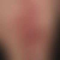 Lichen planus atrophicans. atrophying Lichen planus existing for several years. recurrent, sponta...