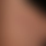 Pseudolymphoma of the skin: non-itchy, surface-smooth, reddish-brown papules, nodules and plaques...