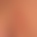 Lupus erythematodes tumidus:&nbsp;seit mehreren Jahren chronisch rezidivierendes Krankheitsbild. ...