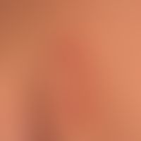 Lupus erythematodes tumidus:&nbsp;seit mehreren Jahren chronisch rezidivierendes Krankheitsbild. ...