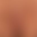 Pilonidalisinus: years of torturous course of the inflammation with wetting, purulent secretion, ...