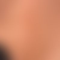 Morphea-Typ oder Plaque-Typ der zirkumskripten Sklerodermie: kuam idurierte unregelmäßig berandet...