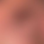 Skin ulcer: ulcerated basal cell carcinoma of the nose.
