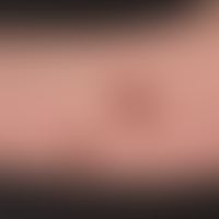 Kaposi's sarcoma epidemic: Dissemination of the angiosarcoma in the skin. Here individual nodes o...