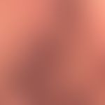 Kaposi's sarcoma endemic: detailed view. reddish-brown, surface smooth plaques and nodules in adv...
