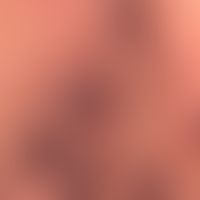 Nodes red-brown:several smooth-surfaced, hemispherical, soft-elastic nodes in endemic Kaposi's sa...