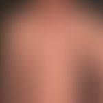 Kaposi's sarcoma: disseminated angiosarcoma. Randomly distributed, non-itching and non-painful, r...