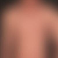 Kaposi's sarcoma: disseminated angiosarcoma. Randomly distributed, non-itching and non-painful, r...
