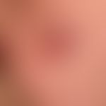 Primary cutaneous follicular center lymphoma: Firm , clearly elevated above the skin level, grown...