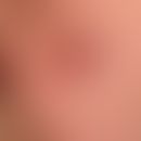 Primär kutanes B-Zell-Lymphom follikuläres.&nbsp;Fester, deutlich über das Hautniveau erhabener, ...
