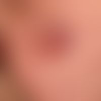 Primär kutanes B-Zell-Lymphom follikuläres.&nbsp;Fester, deutlich über das Hautniveau erhabener, ...