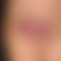 nodule red ulcerated: solitary , about 10 weeks old, slowly progressing in size, moderately press...