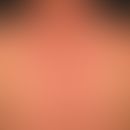Xanthomas, eruptive:0.1-0.3 cm large, yellow-brown, flat raised, superficially smooth and shiny, ...