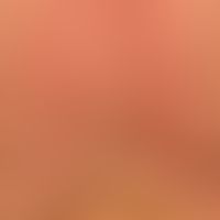 Xanthomas, eruptive:disseminated, 0.1-0.3 cm large, yellow-brown, flat raised, superficially smoo...