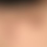 Kollagenose, reaktive perforierende:&nbsp;Detailaufnahme. &nbsp;Ältere und jüngere Effloreszenzen...