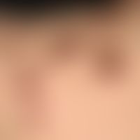 Kollagenose, reaktive perforierende:&nbsp;Detailaufnahme. &nbsp;Ältere und jüngere Effloreszenzen...